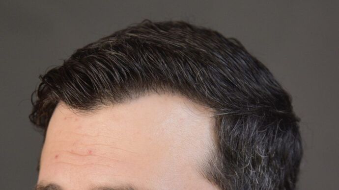 FUT Hair Restoration: Case 4 - After