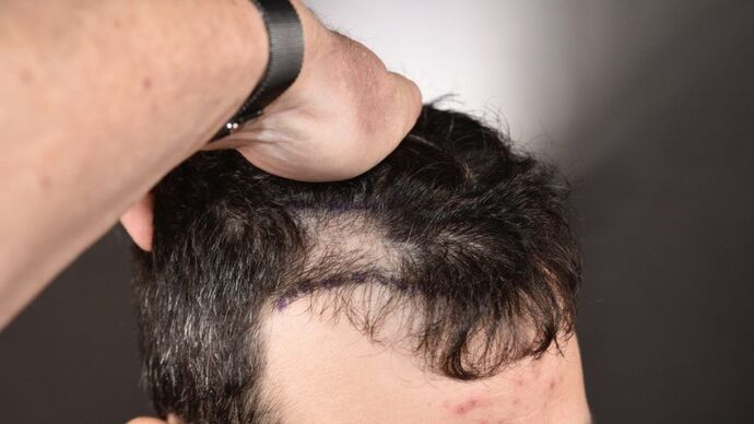 FUT Hair Restoration: Case 4 - Before