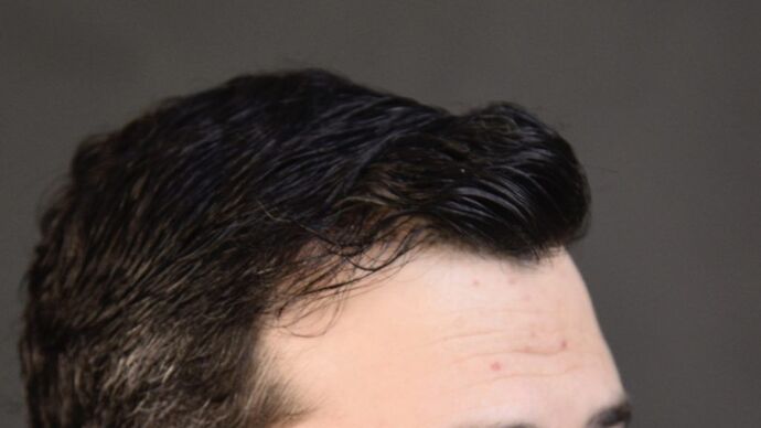 FUT Hair Restoration: Case 4 - After