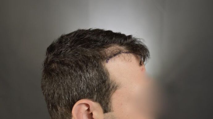 FUT Hair Restoration: Case 4 - Before