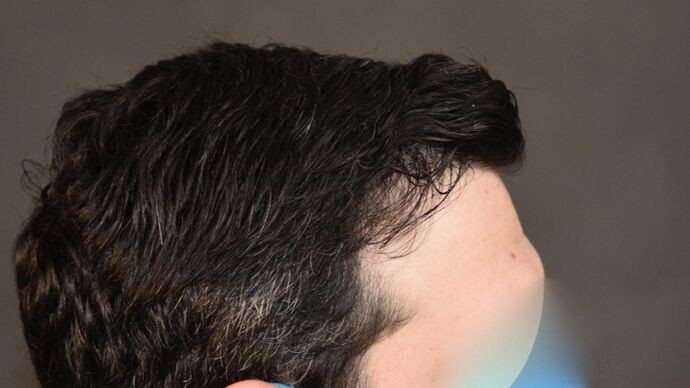 FUT Hair Restoration: Case 4 - After