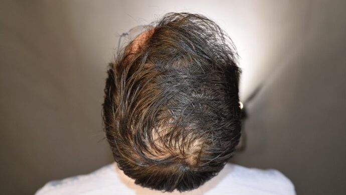 FUT Hair Restoration: Case 5 - After