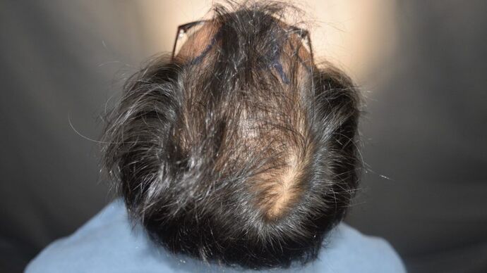 FUT Hair Restoration: Case 5 - Before