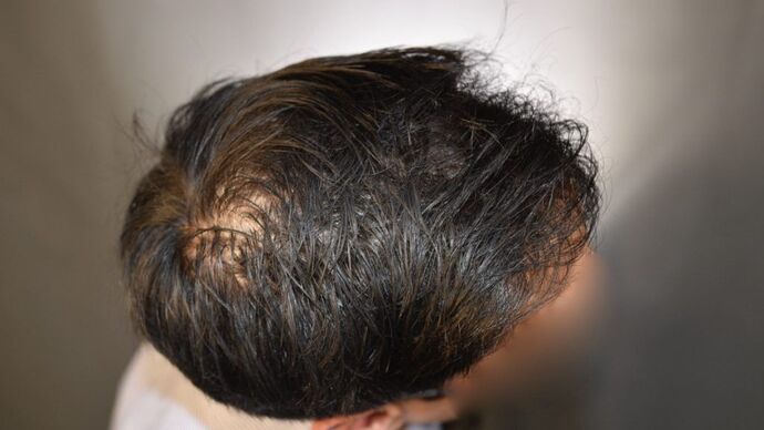 FUT Hair Restoration: Case 5 - After