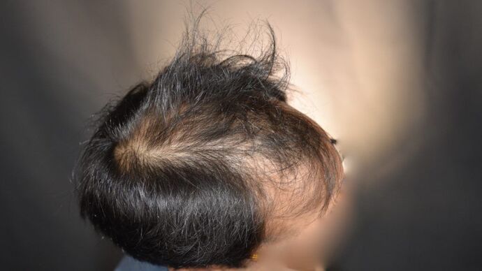 FUT Hair Restoration: Case 5 - Before