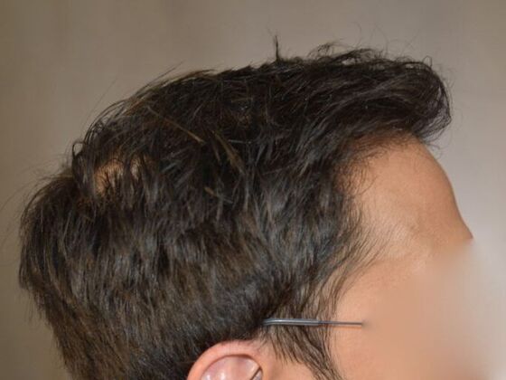 FUT Hair Restoration: Case 5 - After