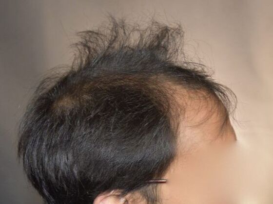 FUT Hair Restoration: Case 5 - Before