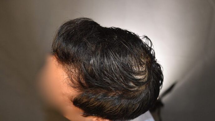 FUT Hair Restoration: Case 5 - After