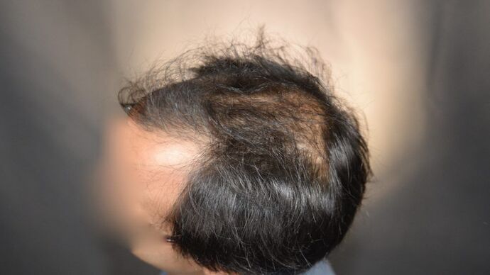 FUT Hair Restoration: Case 5 - Before