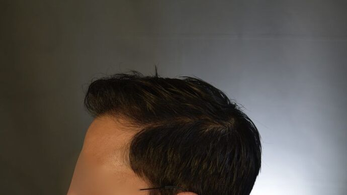 FUT Hair Restoration: Case 5 - After