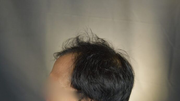 FUT Hair Restoration: Case 5 - Before