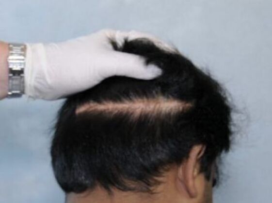 FUT Hair Restoration Case 6 - Before
