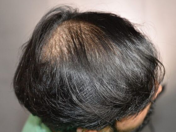 FUT Hair Restoration: Case 6 - After