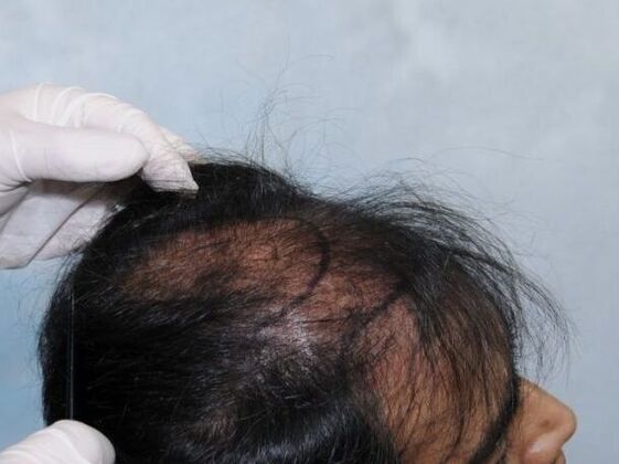 FUT Hair Restoration: Case 6 - Before