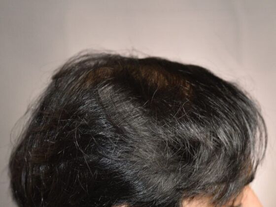 FUT Hair Restoration: Case 6 - After