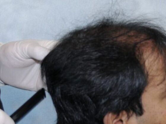 FUT Hair Restoration: Case 6 - Before