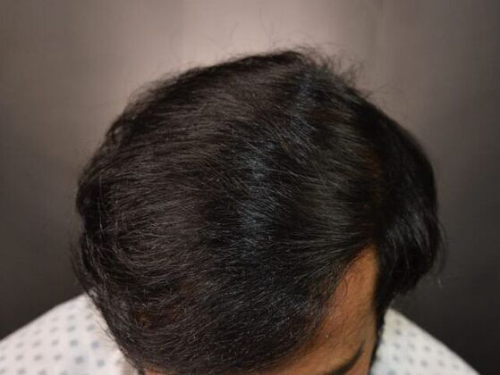 FUT Hair Restoration: Case 6 - After