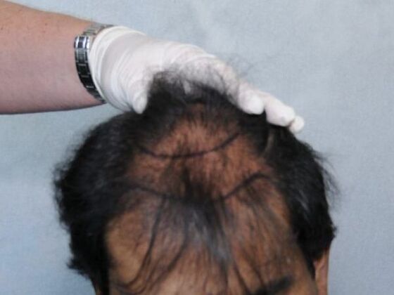 FUT Hair Restoration: Case 6 - Before