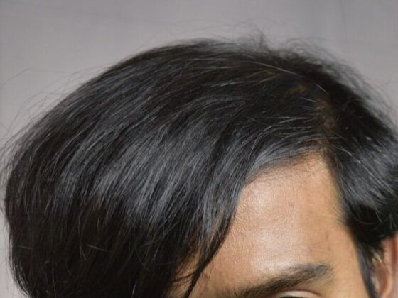 FUT Hair Restoration: Case 6 - After