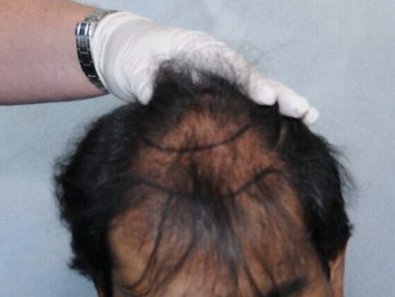 FUT Hair Restoration: Case 6 - Before