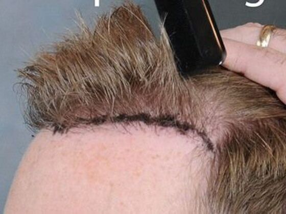 FUT Hair Restoration Case 7 - Before