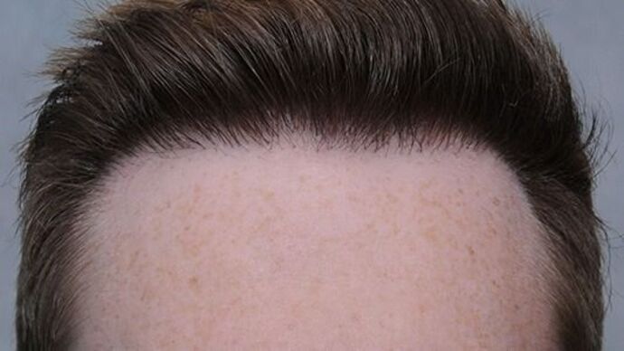 FUT Hair Restoration: Case 7 - After