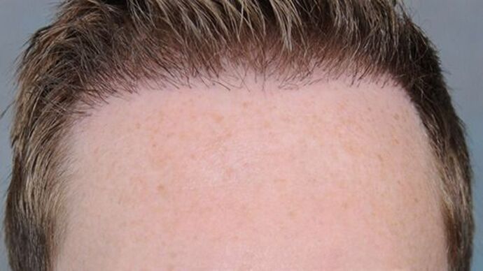 FUT Hair Restoration: Case 7 - Before