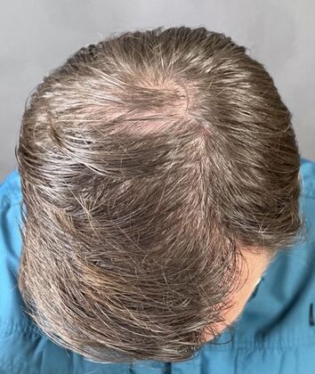 FUT Hair Restoration: Case 8 - After