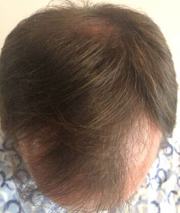 FUT Hair Restoration: Case 8 - Before