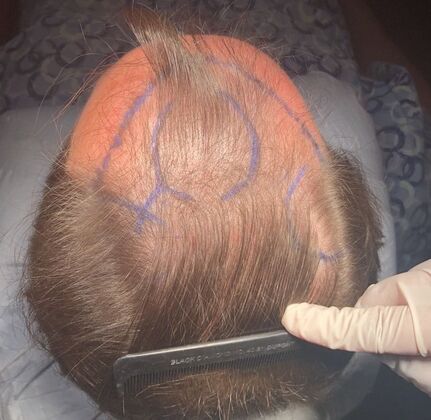 FUT Hair Restoration: Case 8 - Before