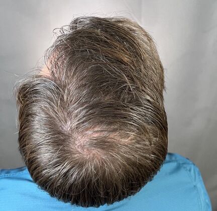 FUT Hair Restoration: Case 8 - After