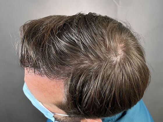 FUT Hair Restoration Case 8 - After