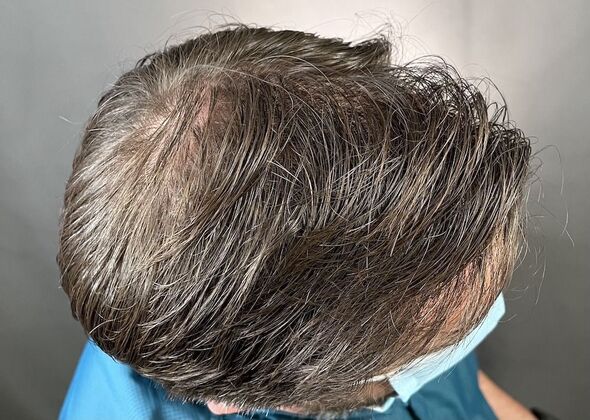 FUT Hair Restoration: Case 8 - After