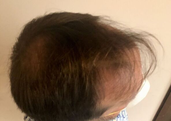 FUT Hair Restoration: Case 8 - Before