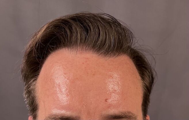 FUT Hair Restoration: Case 8 - After