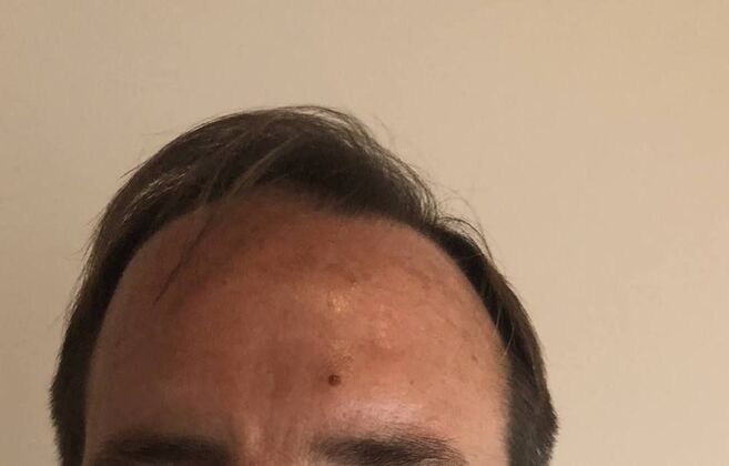 FUT Hair Restoration: Case 8 - Before