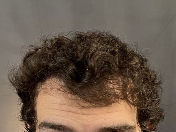 FUT Hair Restoration Case 9 - After