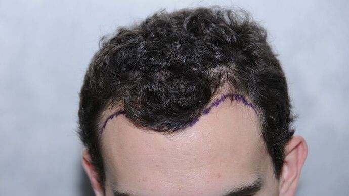 FUT Hair Restoration: Case 9 - Before