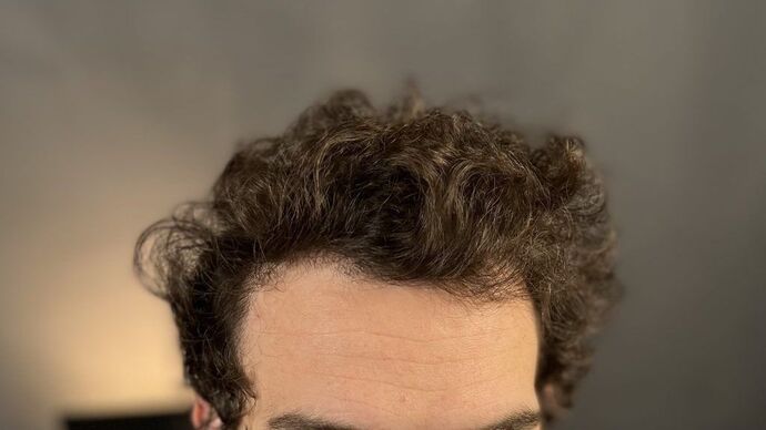 FUT Hair Restoration: Case 9 - After