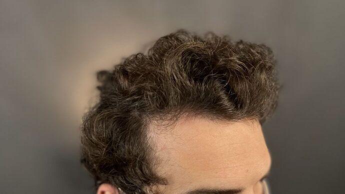 FUT Hair Restoration: Case 9 - After