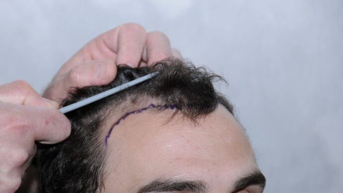 FUT Hair Restoration: Case 9 - Before