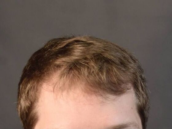 FUT Hair Restoration Case 10 - After