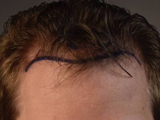 FUT Hair Restoration Case 10 - Before