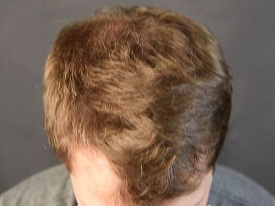 FUT Hair Restoration: Case 10 - After