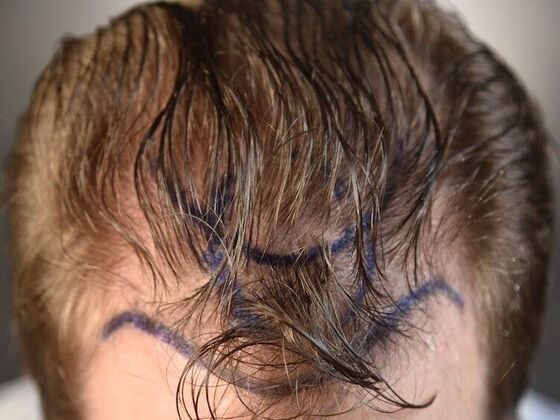 FUT Hair Restoration: Case 10 - Before