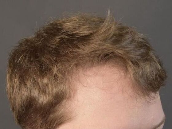 FUT Hair Restoration: Case 10 - After