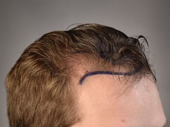 FUT Hair Restoration: Case 10 - Before