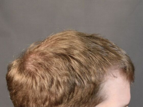 FUT Hair Restoration: Case 10 - After