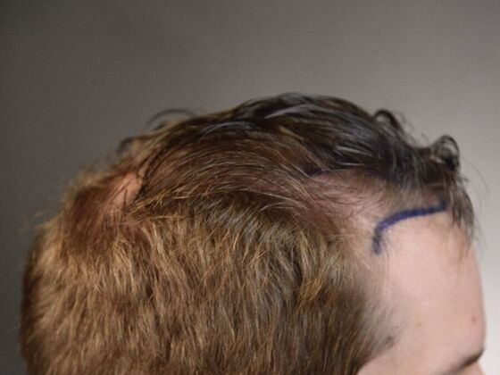 FUT Hair Restoration: Case 10 - Before