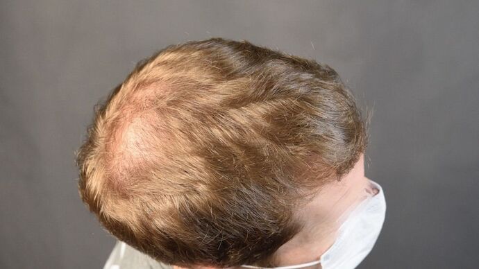 FUT Hair Restoration: Case 10 - After